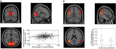 Genetics Modulate Gray Matter Variation Beyond Disease Burden in Prodromal Huntington’s Disease